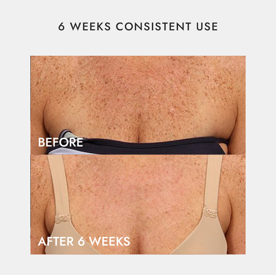 Neck & Décolletage LED Recover, Repair & Reversal Device