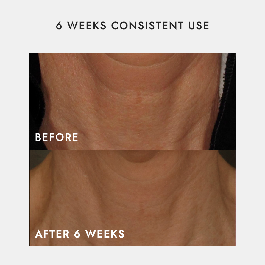 Neck & Décolletage LED Recover, Repair & Reversal Device