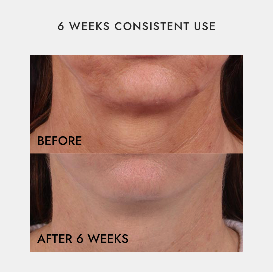 Neck & Décolletage LED Recover, Repair & Reversal Device