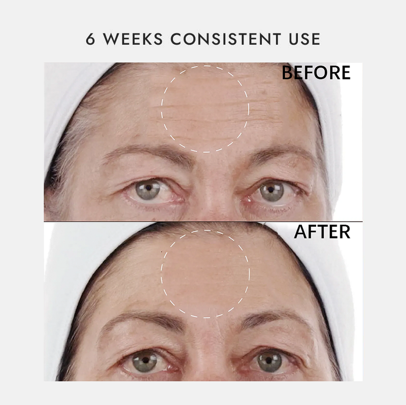 Microcurrent Facial Before And After